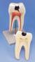 Ząb - dolny trzonowy, model dwukorzeniowy, 2-częściowy 